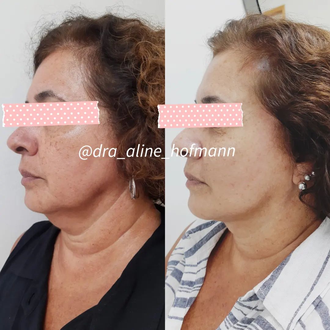 Resultado de Lipoaspiraçao cirúrgica de papada