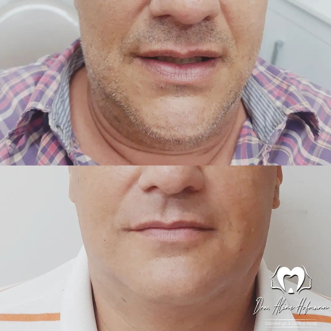 Lipoaspiração de papada cirúrgica, o preenchimento da mandíbula e jowls e o refinamento com ácido hialurônico do bigode chinês.