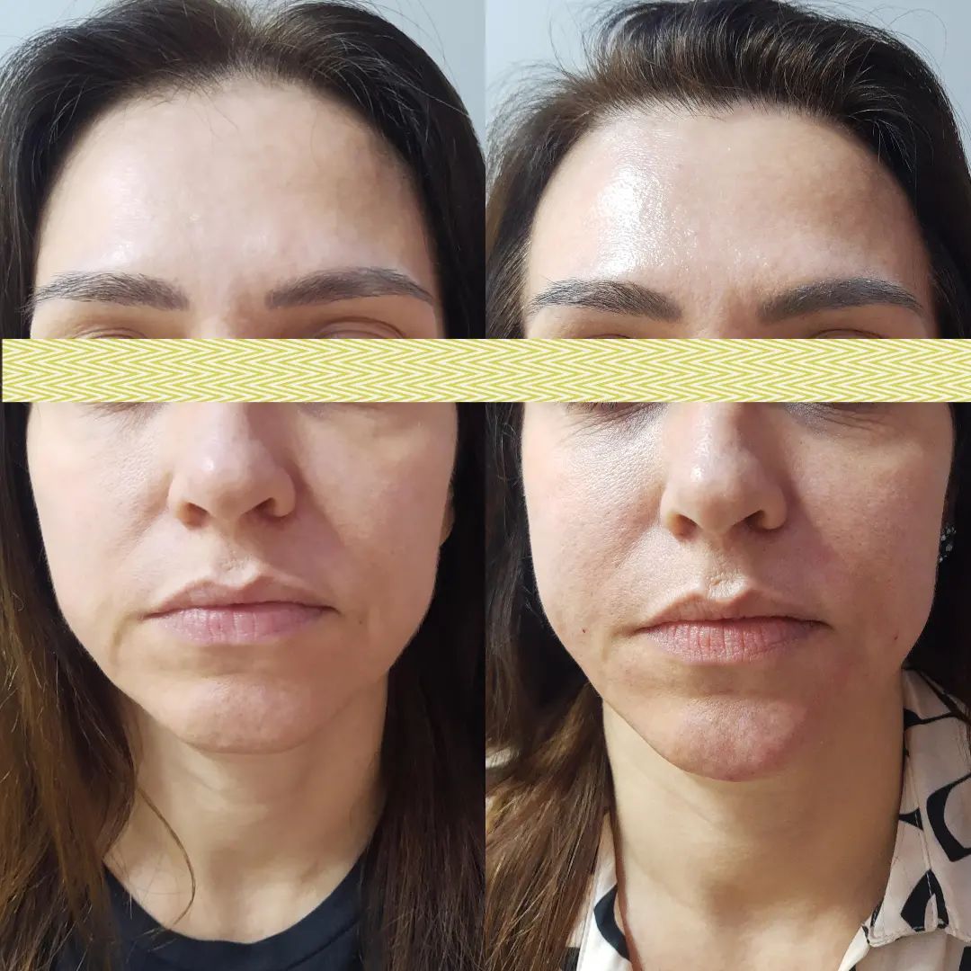 Resultado final da sua harmonização facial.