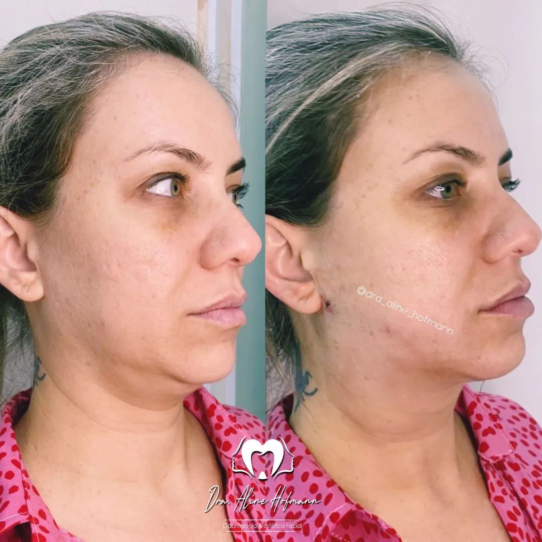 Após 10 dias de lipoaspiração cirúrgica de papada e de jowls.