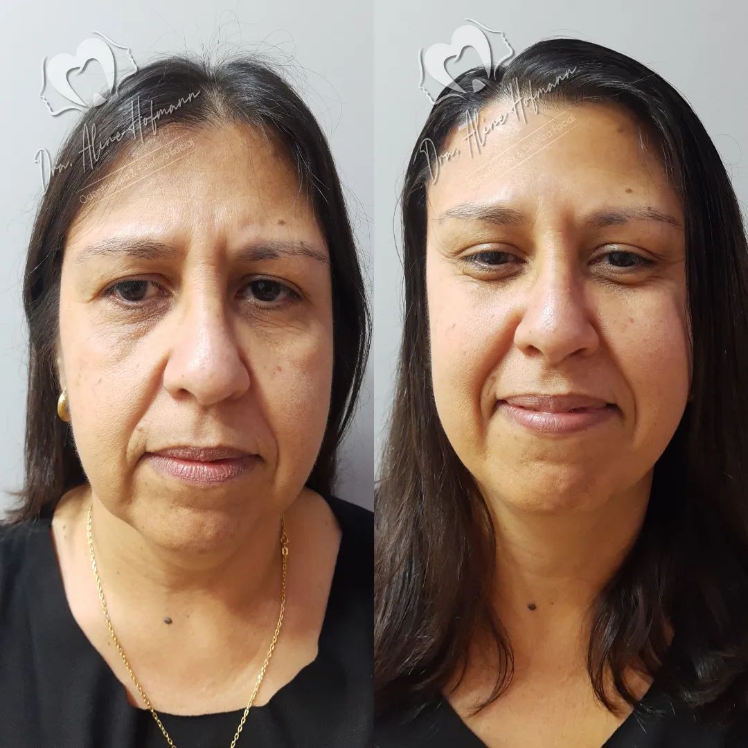 Vai ter q vir para o feed esse caso maravilhoso de Lifting de temporal.