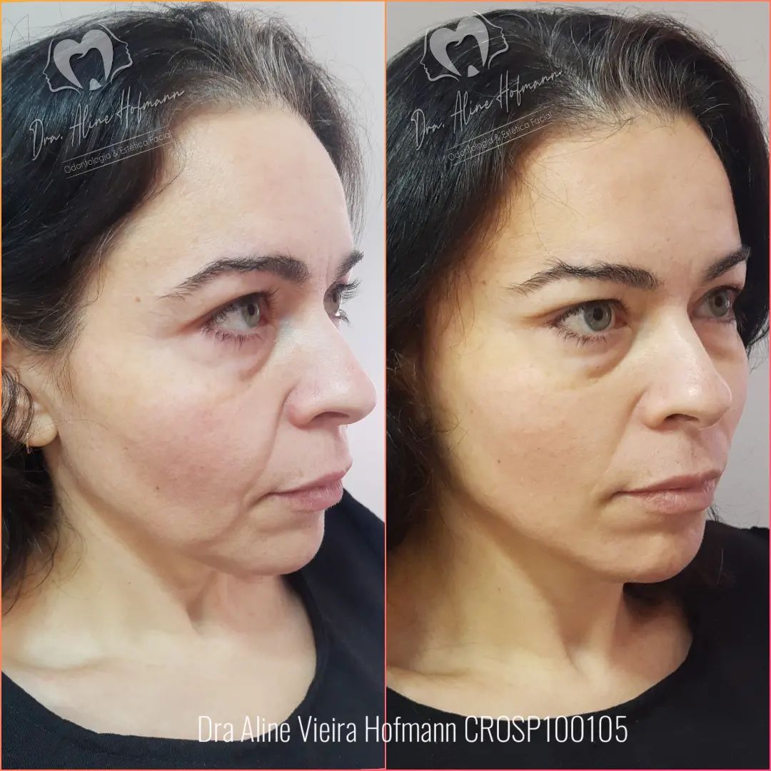 Mais um resultado incrível dessa maravilhosa técnica de lifting de temporal.