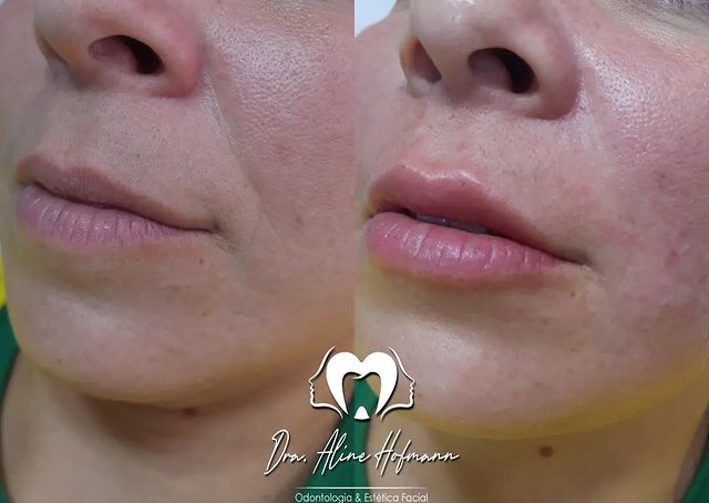 Preenchimento Labial e do bigode chinês.